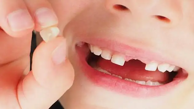 Süt dişlerin erken kaybına dikkat!