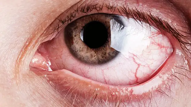 Gözünüzde batma varsa dikkat: Göz taşınız olabilir