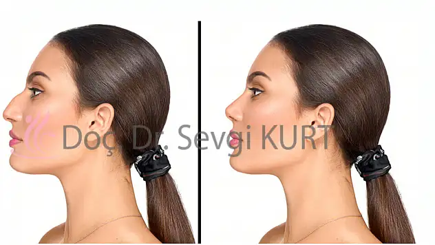 Burun Estetiği(Rinoplasti)