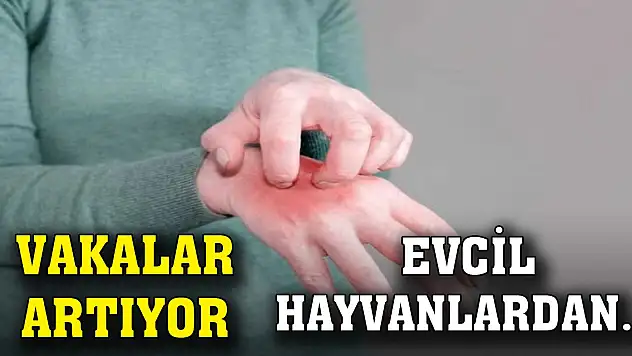 Uyuz vakaları artıyor