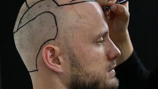 Doğallıktan Ödün Vermeyen Saç Ekimi: Hair Center of Turkey