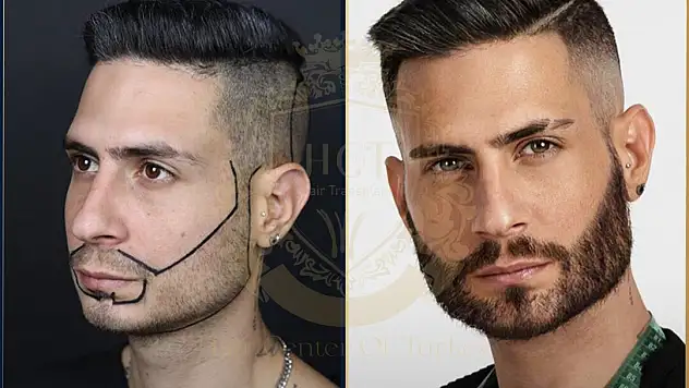 Sakalınıza Özel Bakım: Hair Center of Turkey Sakal Ekimi