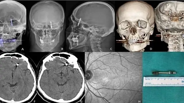 İmplant tedavisinde vida beynine saplandı