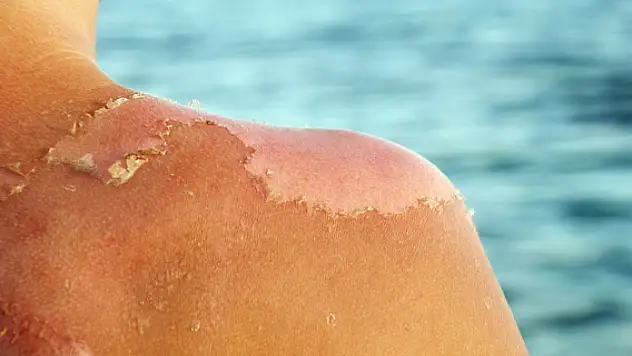 Güneş yanığı deyip geçmeyin! O riski arttırıyor