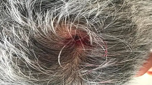 Ceviz büyüklüğündeki dolu vatandaşın kafasını yardı