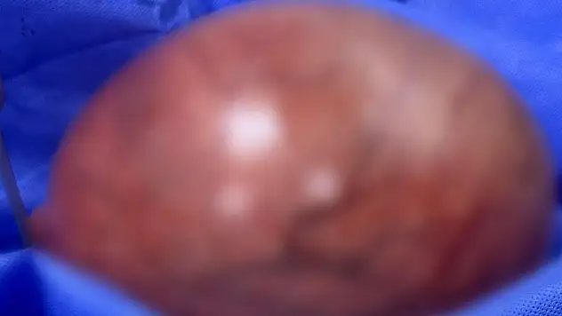 Kilo aldığını sandı, rahminden 5,5 kilo kitle çıktı