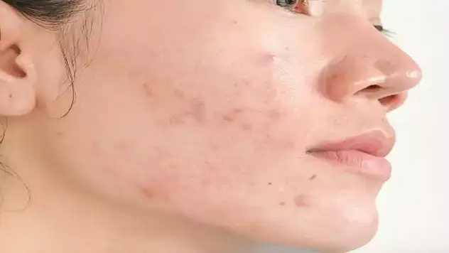 Cildin düşmanı: 'Stres'