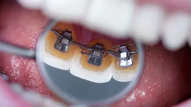 Ortodontide Sık Sorulanlar