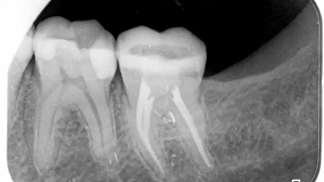 Diş Tedavisinde Dijital Teknoloji