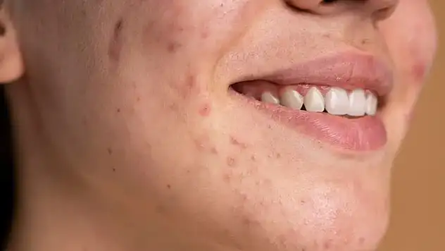 Akne Tedavisi Hakkında Bilmeniz Gerekenler