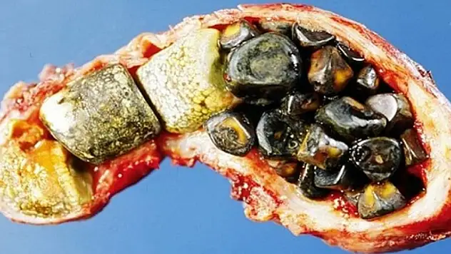 Safra taşları hakkında doğru sanılan 12 yanlış bilgi