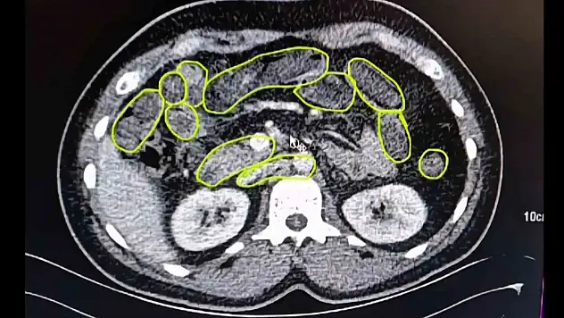 Mide ve bağırsaklarından bakın ne çıktı