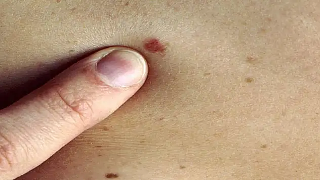 Cilt kanserinden korunmak için bu önemleri mutlaka alın