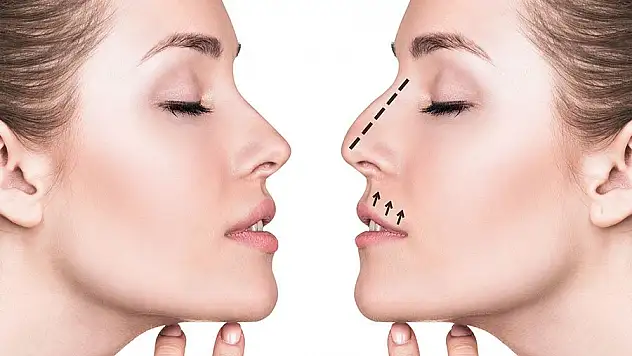 Burun Estetiği (Rinoplasti): Bilmeniz Gereken Her Şey