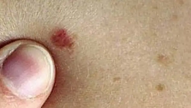 'Benlerin alınması kansere yol açmaz'