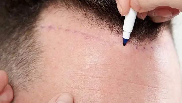 Gids voor Haartransplantatie in Nederland: Kunst, Technologie en Perfecte Resultaten (2025)