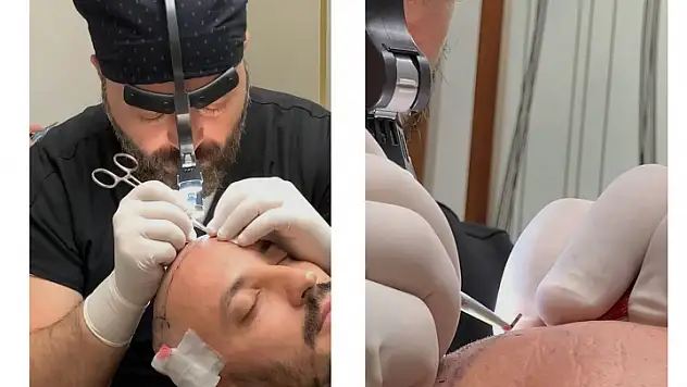 Sapphire DHI - SDHI Hair Transplant: Este Surgery