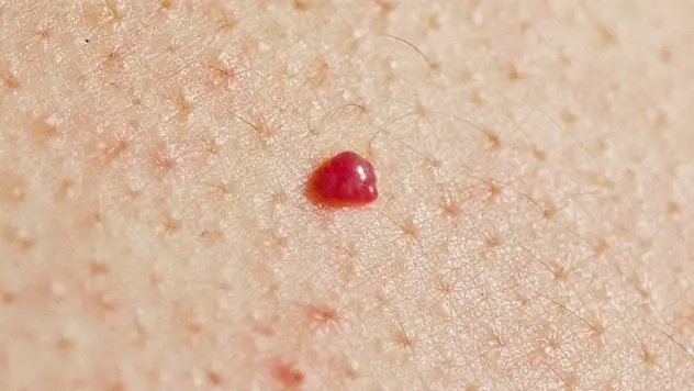 Ciltte beliren kırmızı benlere dikkat