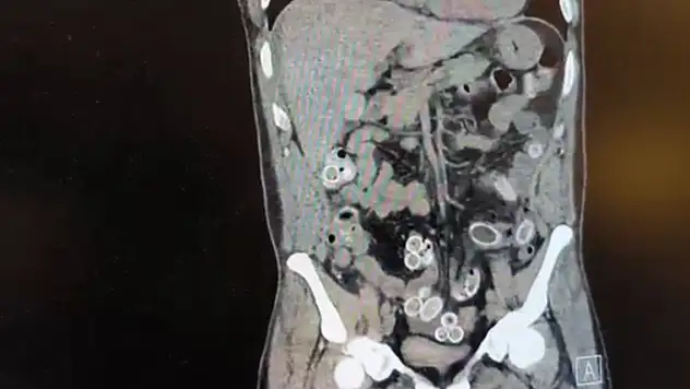 Midesinde uyuşturucu getirdi ameliyatla çıkarıldı