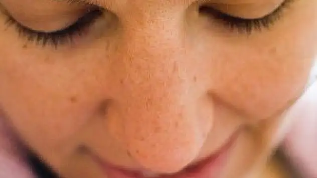 Benler cilt kanserinin habercisi olabilir