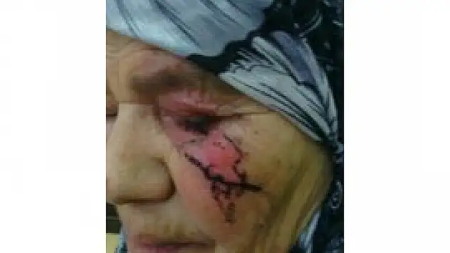 Alevli hortum yaşlı kadının yüzünü yaktı