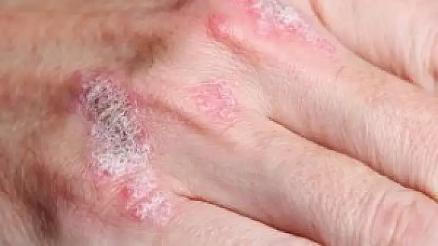 'Kış aylarında deri sağlığına dikkat edilmeli'