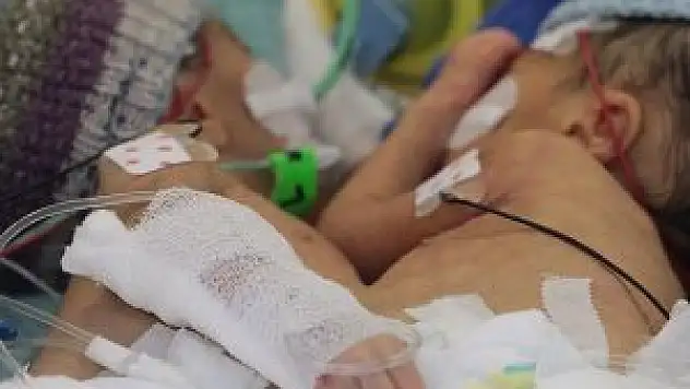 İsviçre'de 8 günlük yapışık ikizler ameliyatla ayrıldı