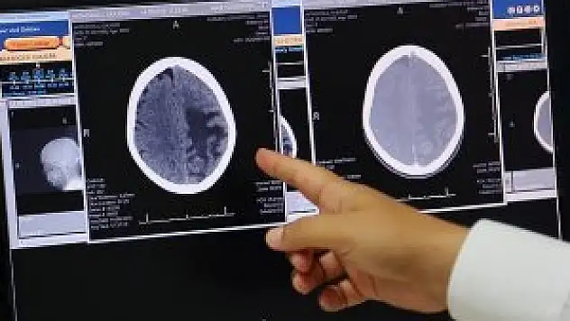 'Beyin damar hastalıkları kazalardan iki kat fazla can alıyor'