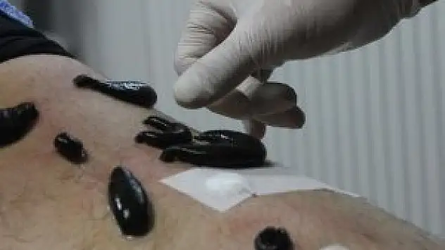 Sülük tedavisinde 'hepatit' uyarısı