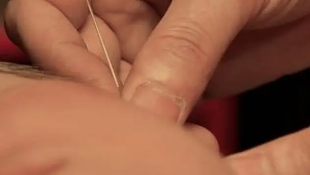 'Akupunkturu ilk bulan Uygur Türkleri'dir'