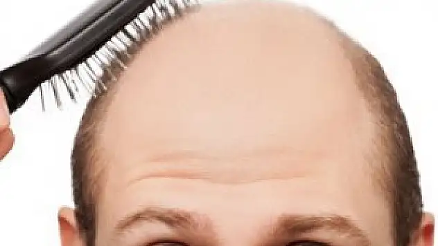 Saç dökülmesinin nedenleri