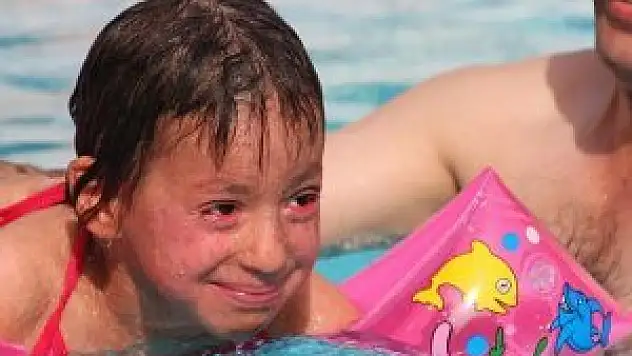 'Balık pulu' hastalığına çareyi termal suda arıyor