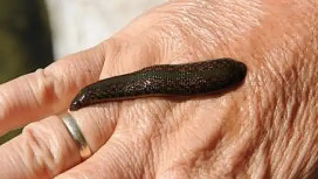 Boğazından canlı sülük çıktı