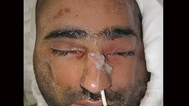 Yüz nakli yapılan Üslün'ün ilk fotoğrafı