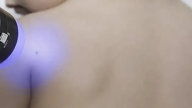 Yapay zeka cilt kanserini teşhis edebiliyor