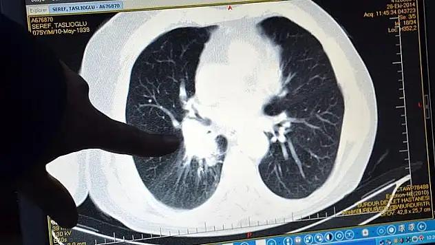 'Türkiye'de erkeklerde en sık akciğer kanseri görülüyor'