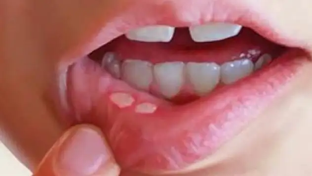 Aft çıkarsa hemen bunu yapın!