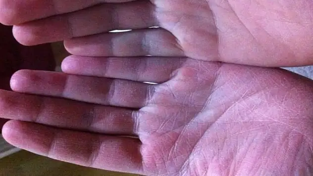 Şeker hastalığının az bilinen erken belirtileri