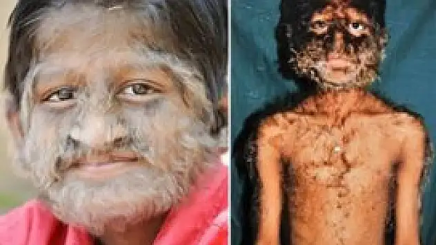 Hipertrikoz: Kurt Adam Sendromu