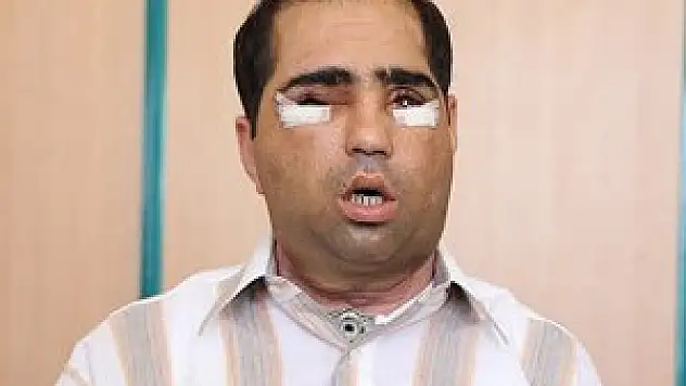 Yüz nakledilen hastaların tedavileri sürüyor