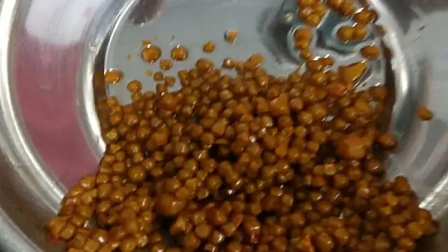 Safra kesesinden 710 taş çıktı