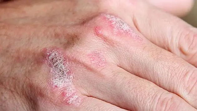 'Obezite ve sigara sedef hastalığını tetikliyor'