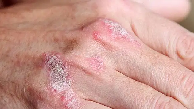 'Sedef hastalığında 'alternatif tedavi vaatleri'ne itibar edilmemeli'