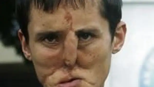 7'nci yüz nakli başladı