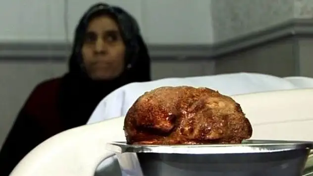 Mesanesinden 1 kilo 30 gram taş çıktı