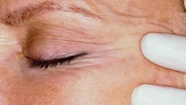 Erken yaşlanma estetik operasyonlara ilgiyi artırdı