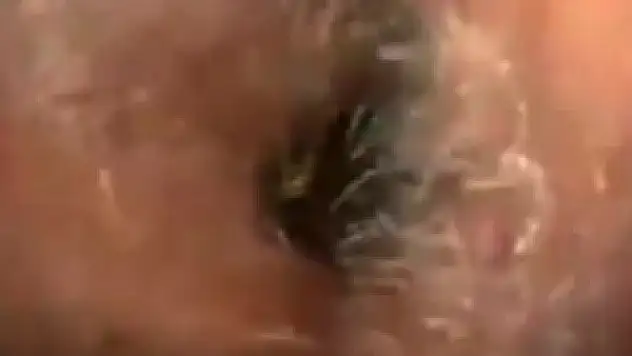 Kulağından hamamböceği çıktı