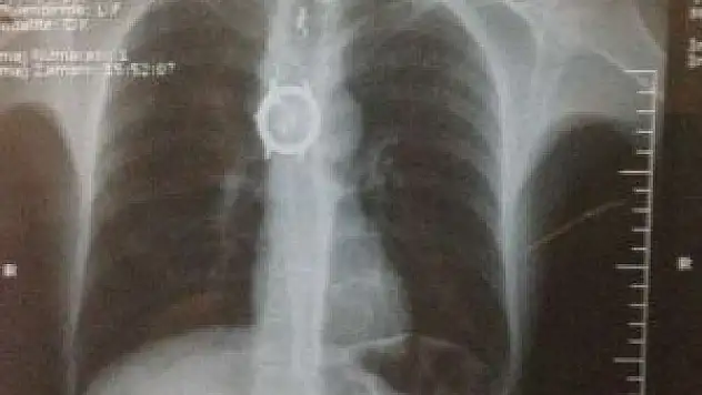 Bir insanın vücudundan kol saati çıkar mı? İşte yanıtı?