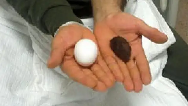 Yumurta büyüklüğünde taş çıktı