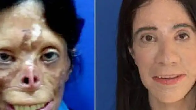 Prof. Dr. Mehmet Mutaf nakilsiz yüz nakli yaptı